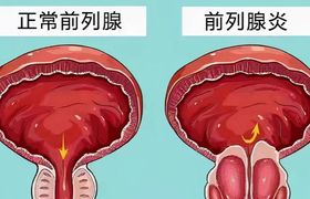 急性前列腺炎什么症状表现