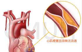 心肌梗塞会怎样