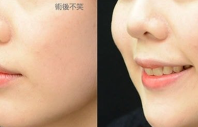 梨涡整形是永久的吗