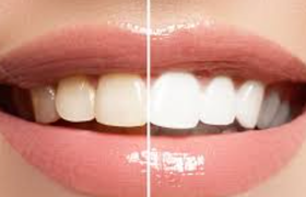 苏打粉美白牙齿吗