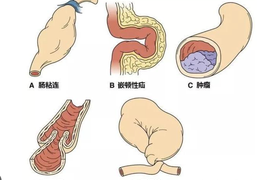 什么是机械性肠梗阻