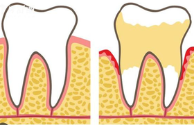 牙龈萎缩是怎么引起的
